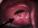 leukoplakia640.jpg (54347 bytes)