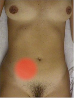Appenicitis250.jpg (17385 bytes)