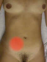 Appendicitis
