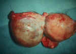ovariancyst640.jpg (56303 bytes)