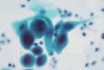 Cervix_trichomonas_with_atypical_sq_metaplasia.jpg (38606 bytes)