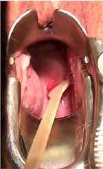 Rotate the Spatula Against the Cervix
