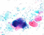 actinomycosis.jpg (46215 bytes)