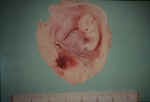 9-Week Spontaneous Abortion