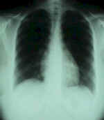 ChestPA.jpg (36789 bytes)