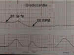 Fetal Bradycardia