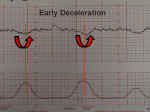 Fetal Early Deceleration