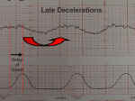 Fetal Late Deceleration
