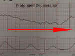 Fetal Prolonged Deceleration