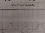 Short Term Variability