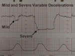 Fetal Mild and Severe Variable Decelerations
