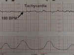 Fetal Tachycardia