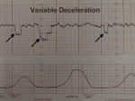 Fetal Variable Deceleration