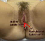Episiotomy.jpg (50073 bytes)