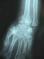 Fractured wrist