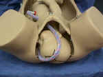 Prolapsed Umbilical Cord