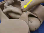 Suprapubic pressure
