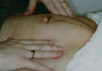 diastasis.jpg (47886 bytes)