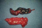 Tubal ectopic pregnancy