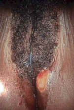 Primary syphilis