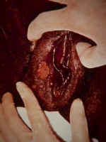 Primary syphilis