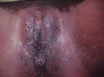 Condyloma Lata (Secondary Syphilis)