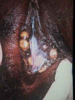Condyloma Lata (Secondary Syphilis)