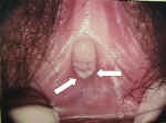 Vestibulitis