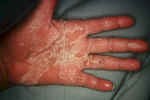 Secondary Syphilis