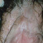 Lichen Sclerosis