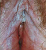 Mixed Dystrophy