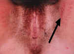 Runner's Rash