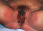 Jock itch