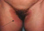 Tinea Cruris