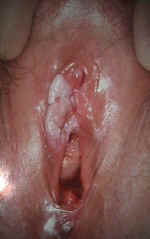 VIN III or Vulvar Intraepithelial Neoplasia III