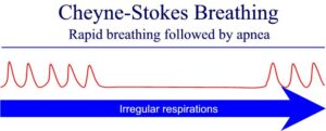 graphic showing Cheyne_Stokes_Breathing