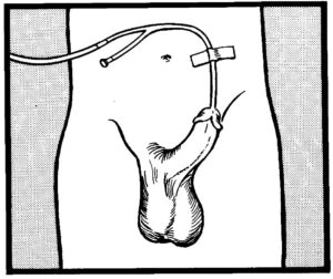 Anchoring (male) indwelling catheter.