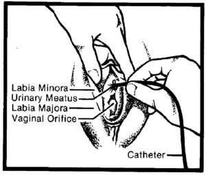 Inserting the catheter in a female.
