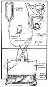 Foley triple lumen catheter. Used to catheterize a male.